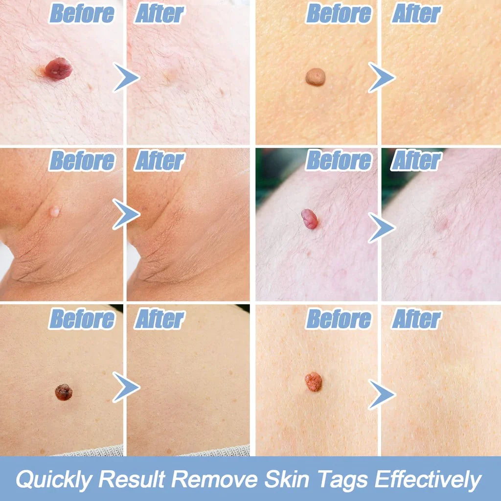 Skin Tag Removal Kit - FLUKLY STORE