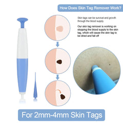 Skin Tag Removal Kit - FLUKLY STORE